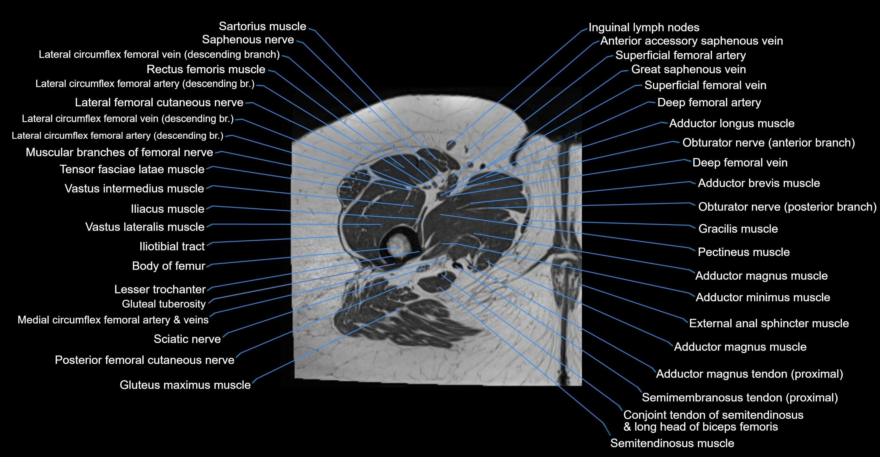 MRI hip axial cross sectional anatomy 3T 3D  radiology  anatomy image-img-00001-00078.webp
